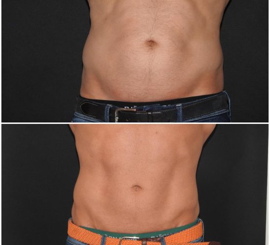 CoolSculpting före och efter 1