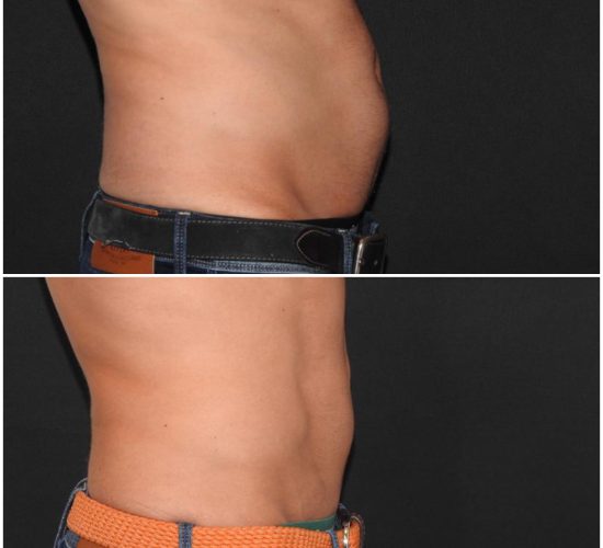 CoolSculpting före och efter 2