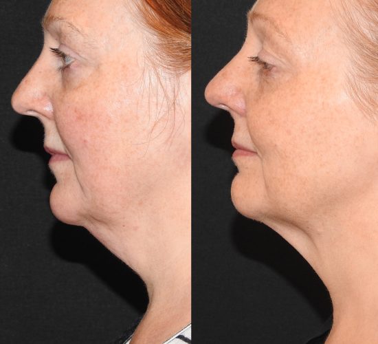 CoolSculpting före och efter 3
