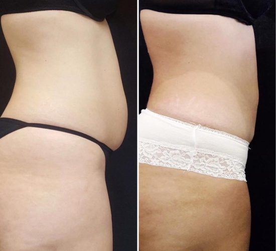 CoolSculpting före och efter 4
