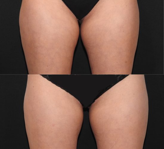 CoolSculpting före och efter 5