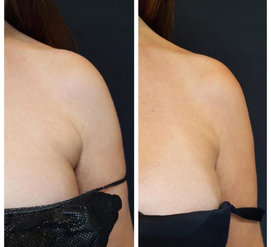 CoolSculpting före och efter 6