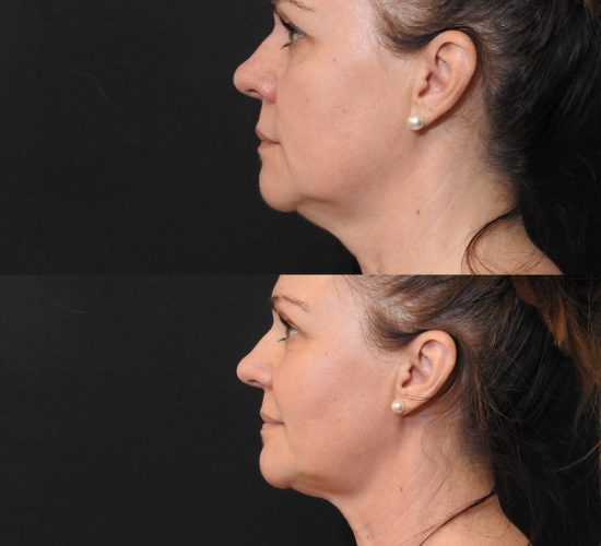 CoolSculpting före och efter 7