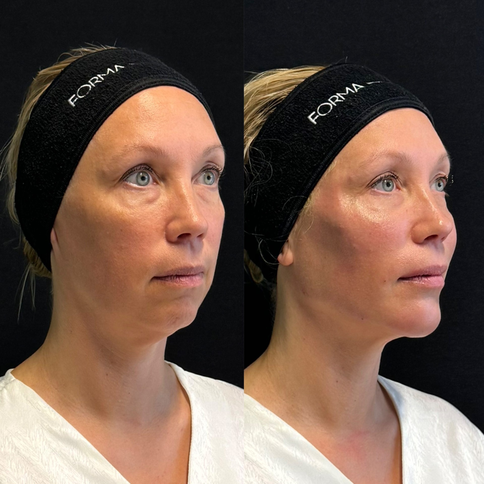 Radiesse före och efter 2
