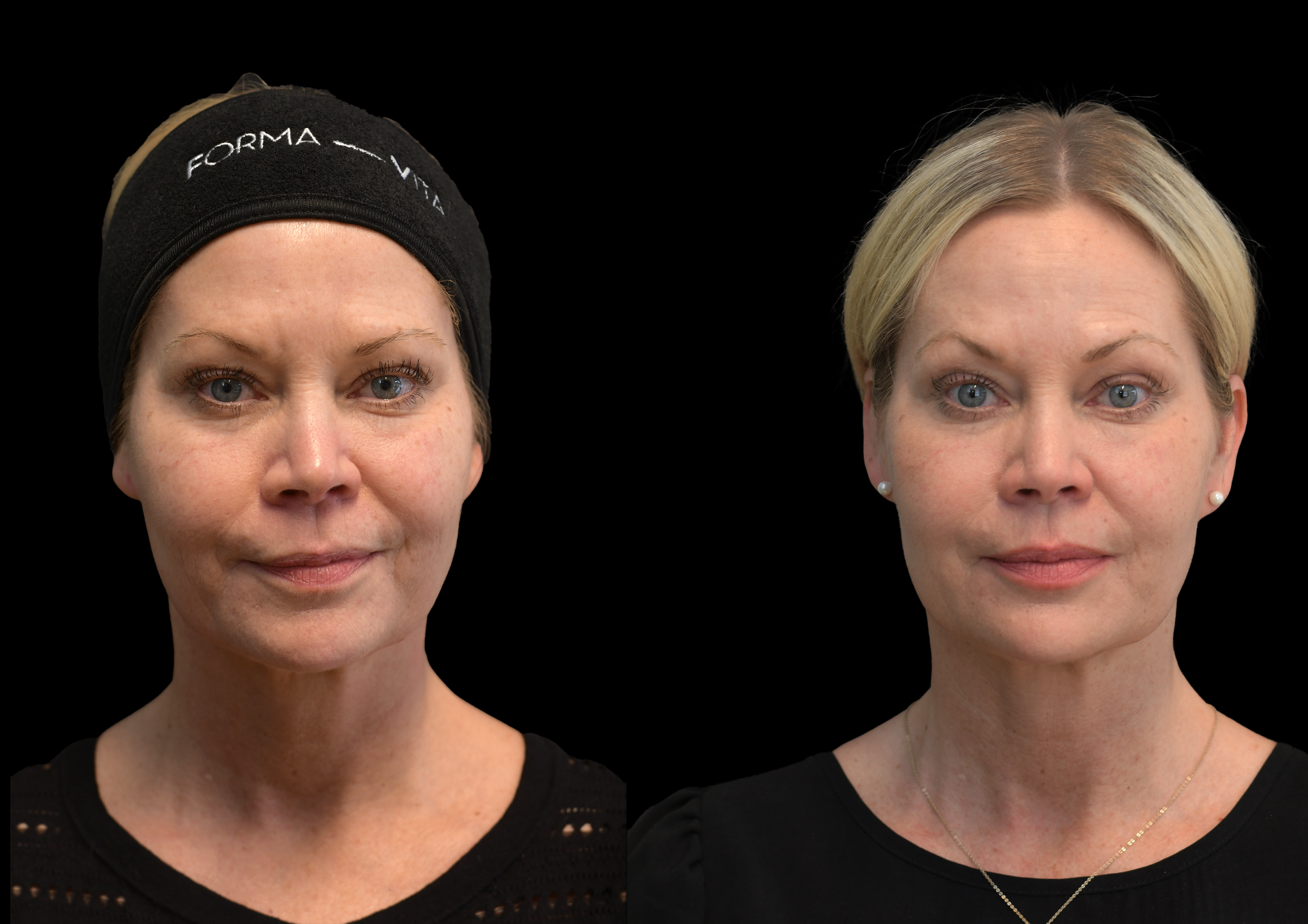 Trådlyft före och efter 4