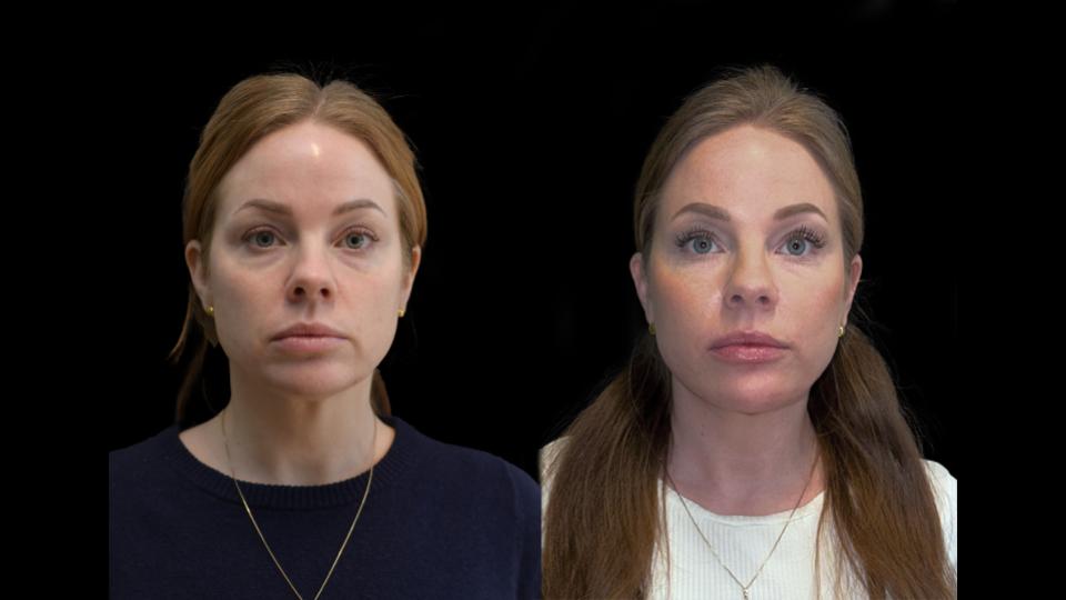 Trådlyft före och efter 9